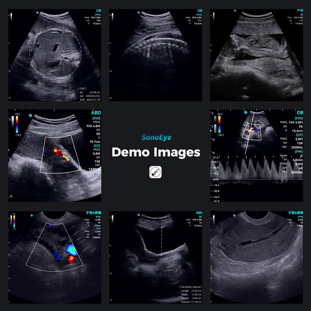 CHISON SonoEye 的愿景是增强女性健康。