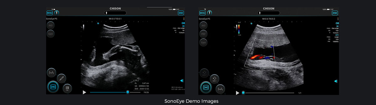 SonoEye 在产科中的应用
