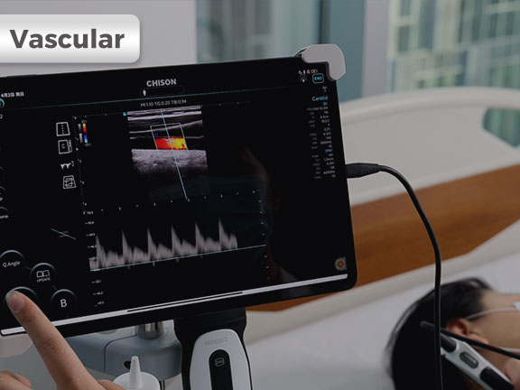 SonoEye 在血管超声中的应用