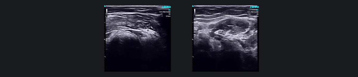 SonoEye 在麻醉中的应用